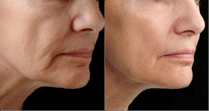 Gesichtshaut vor und nach dem Laser-Resurfacing-Verfahren. 