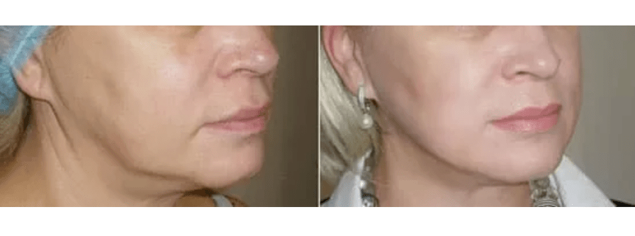 Erholung nach Hautverjüngung